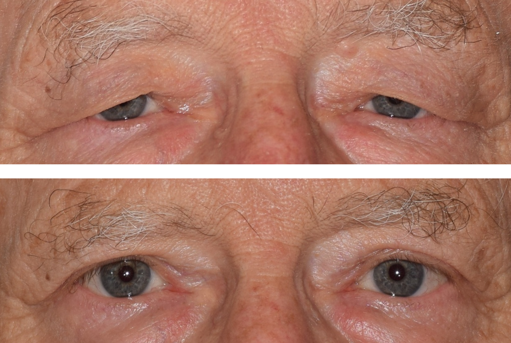 Close up of a before and after of an upper eyelid blepharoplasty.