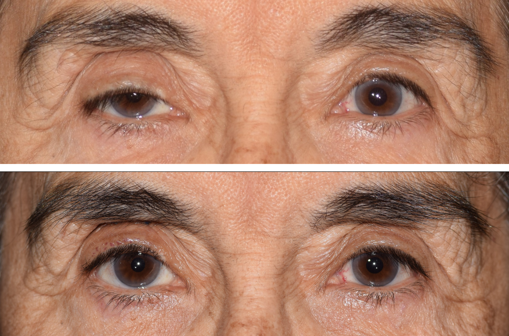 This is a before and after photo of a patient that got ptosis surgery on the right side performed by Dr. Ron Pelton. Ptosis repair lifts the eyelid improving vision and appearance