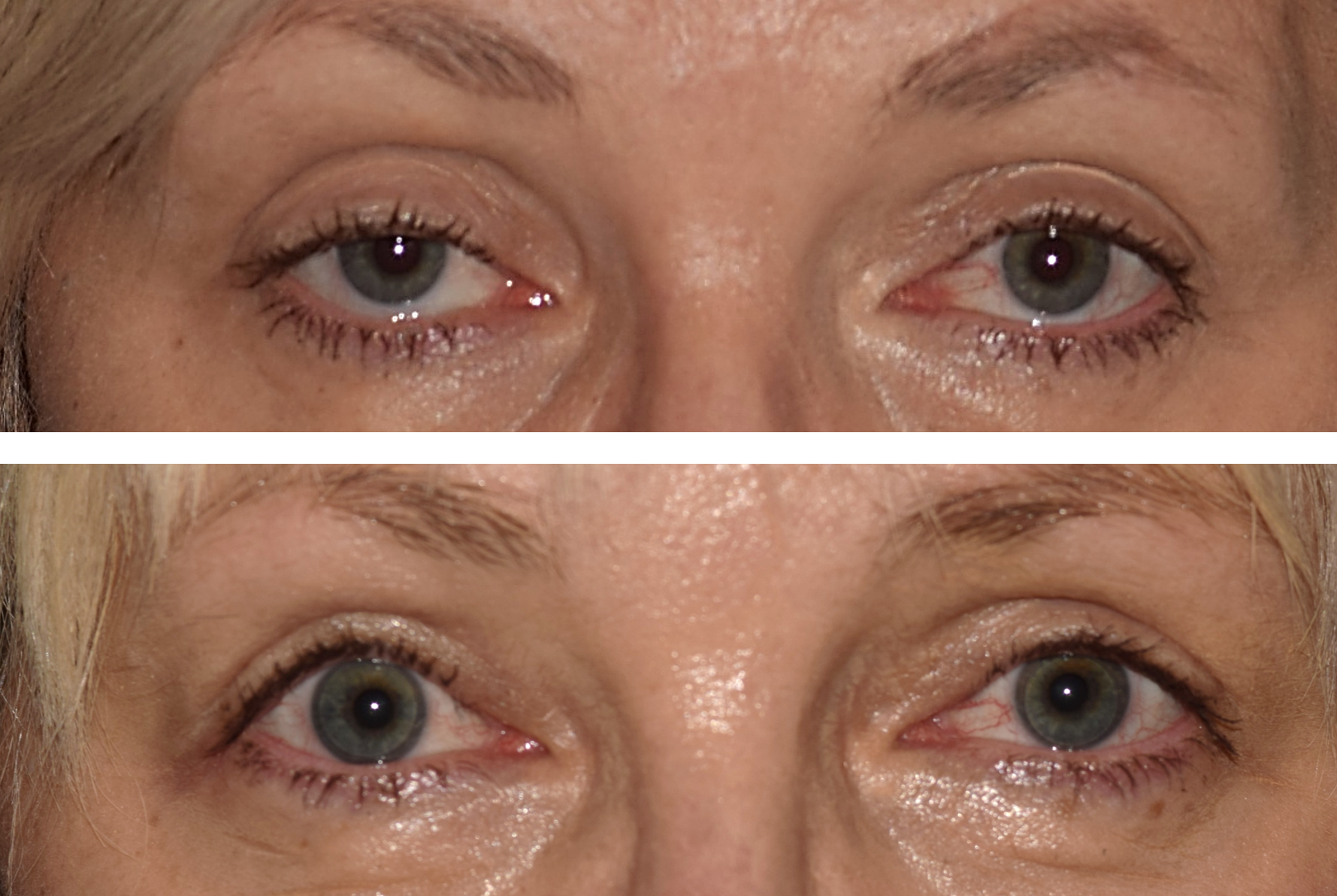 This image shows a woman before her ptosis eyelid surgery and the after with her eyes more open and alert