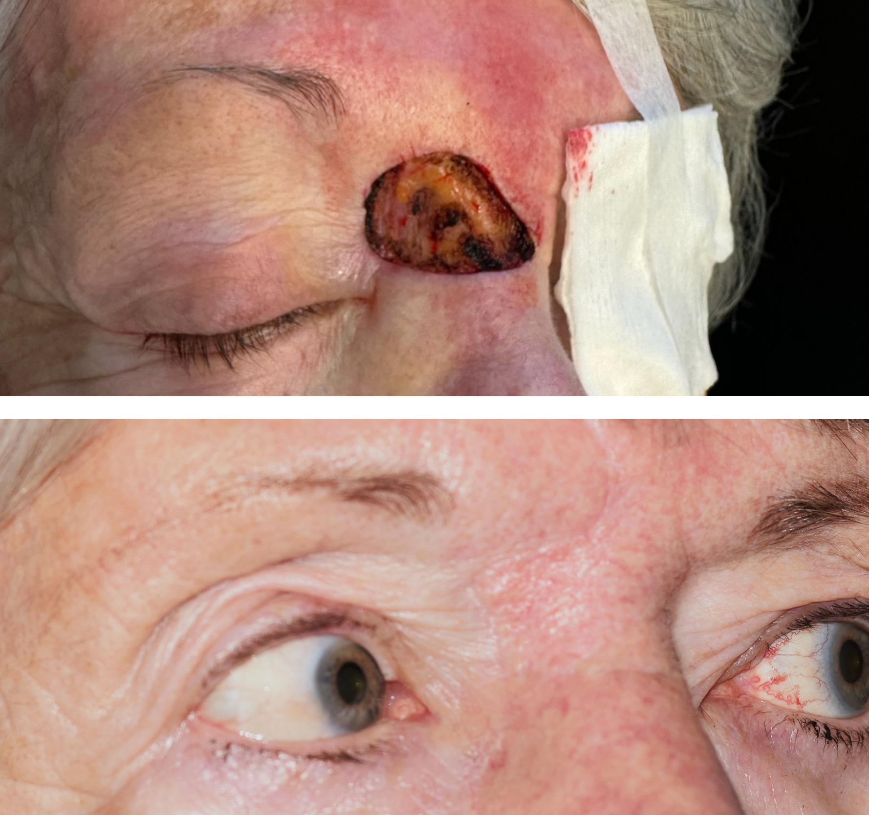 Pictured is a before & after photo of a woman who got her skin cancer removed by getting a Mohs surgery done and the after photo shows the defect healed after Dr. Ron Pelton did the revision. Dr. Pelton reconstructed the nasal area after her Mohs 