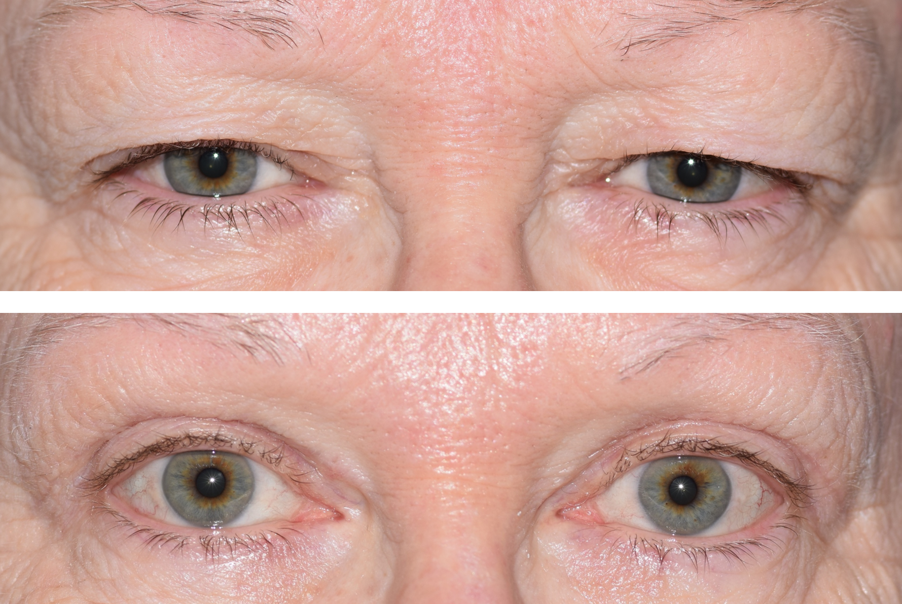 Pictured is a before and after photo after an upper eyelid lid, also called a blepharoplasty done by Dr. Ron Pelton. This surgery removes excess skin on the eyelids and improves vision