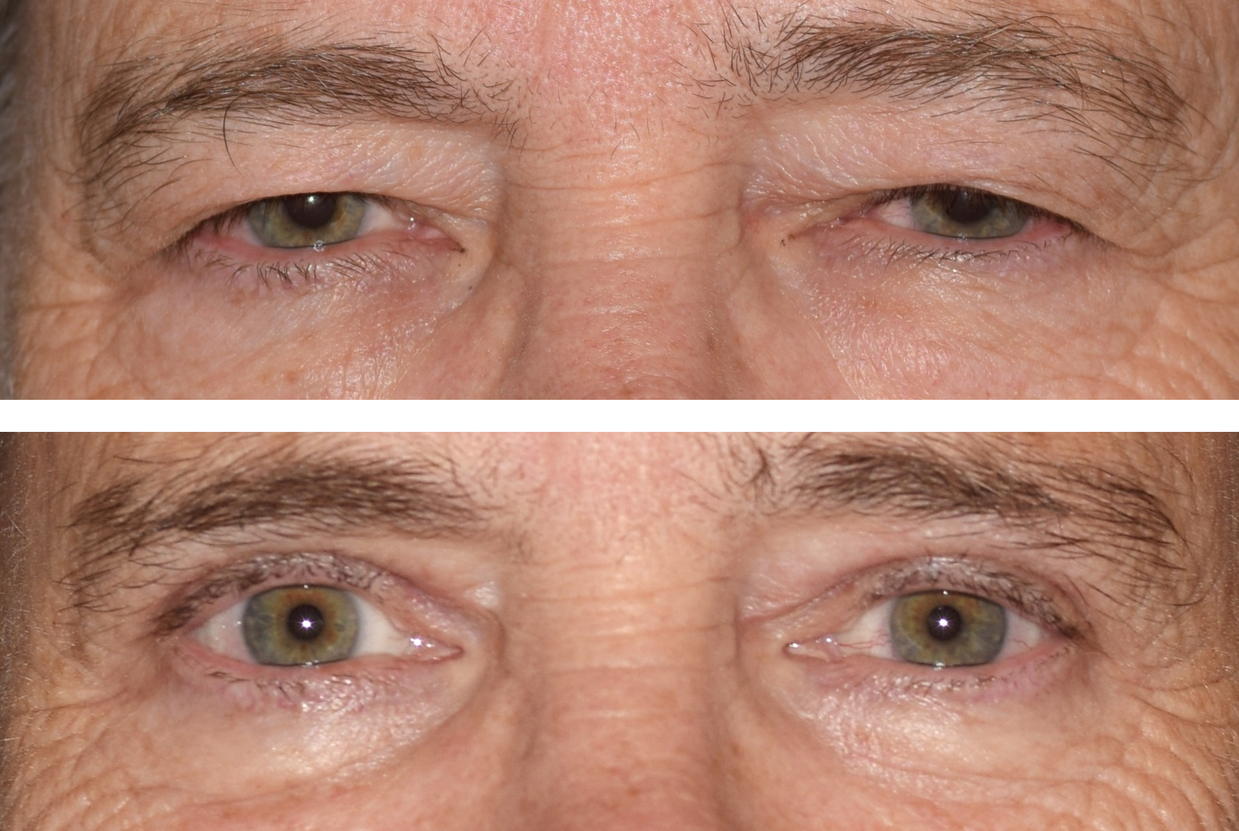 Pictured is a before and after photo after an upper eyelid lid, also called a blepharoplasty done by Dr. Ron Pelton. This surgery removes excess skin on the eyelids and improves vision