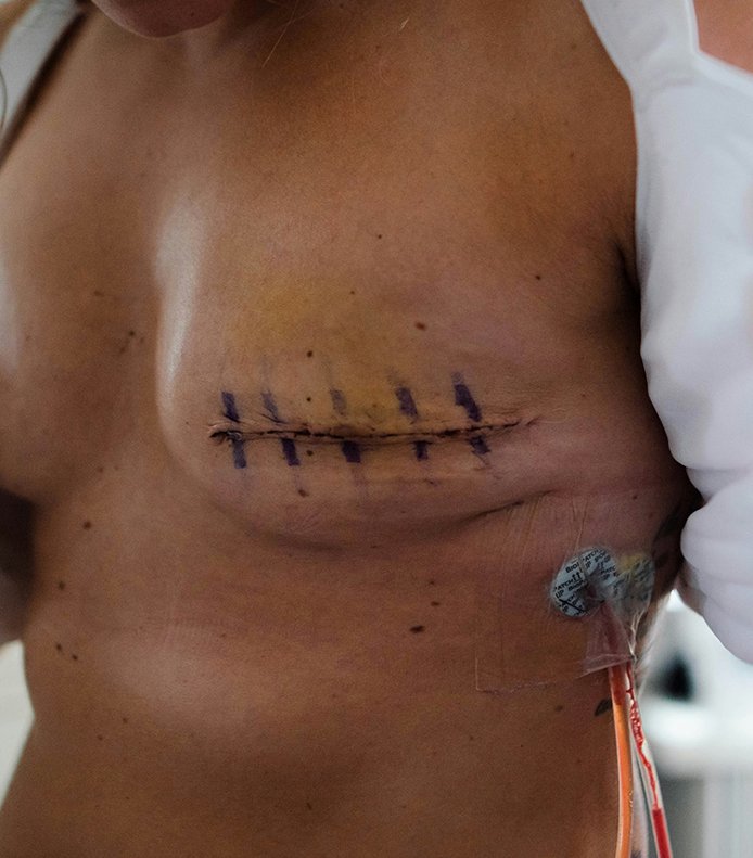 Mastectomy.jpg