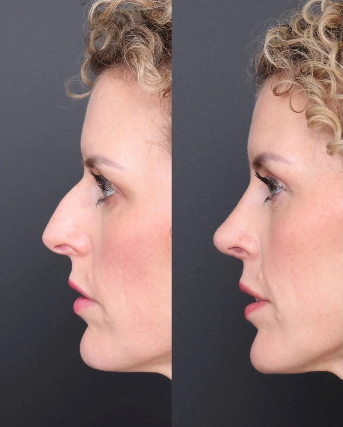 6 week result post rhinoplasty