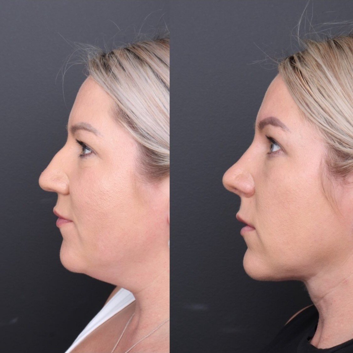 2 month result post functional septorhinoplasty and neck liposuction