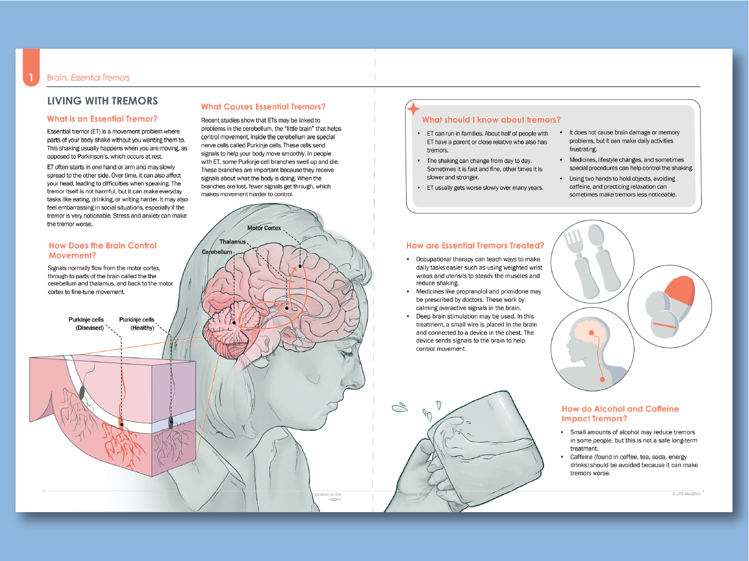 Living with Tremors - A Patient Education Spread