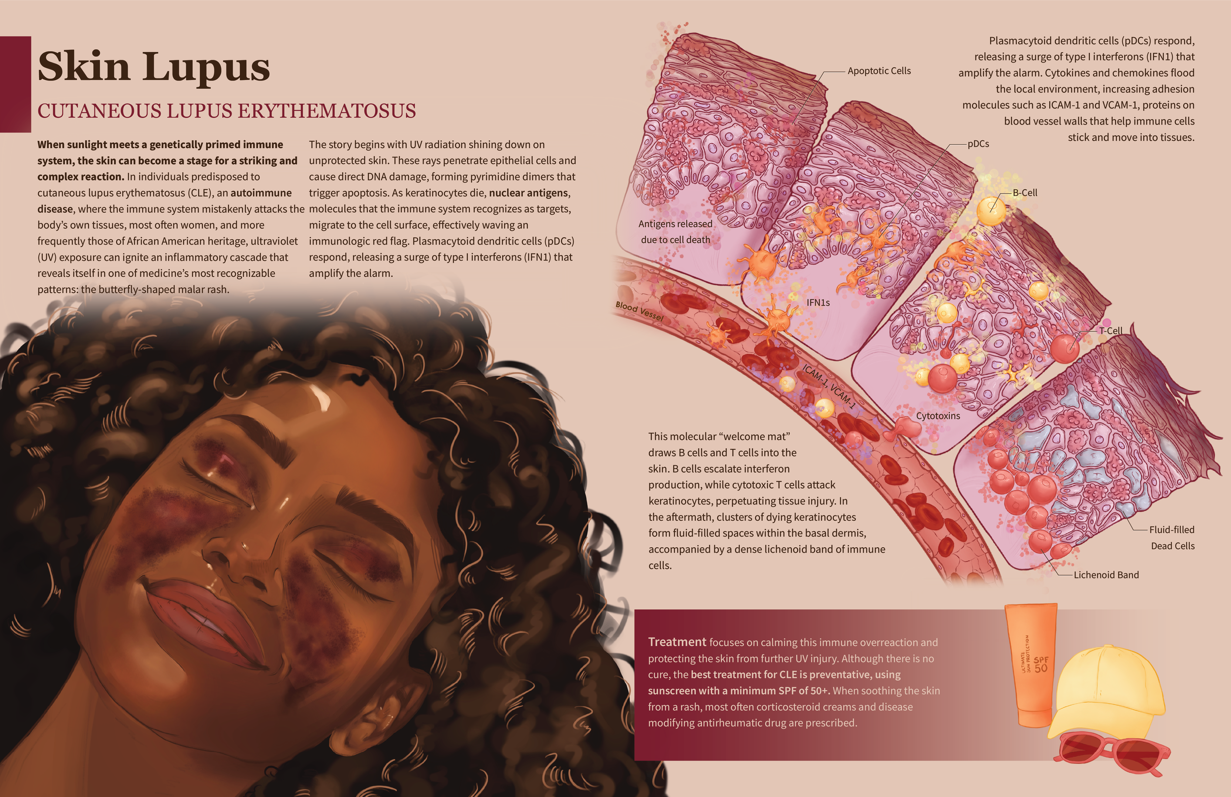 Pathology of Skin Lupus