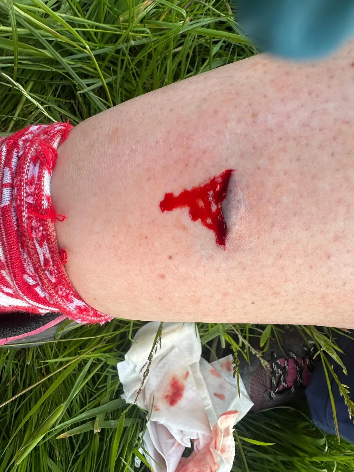 SITW 2025 shin injury.jpeg