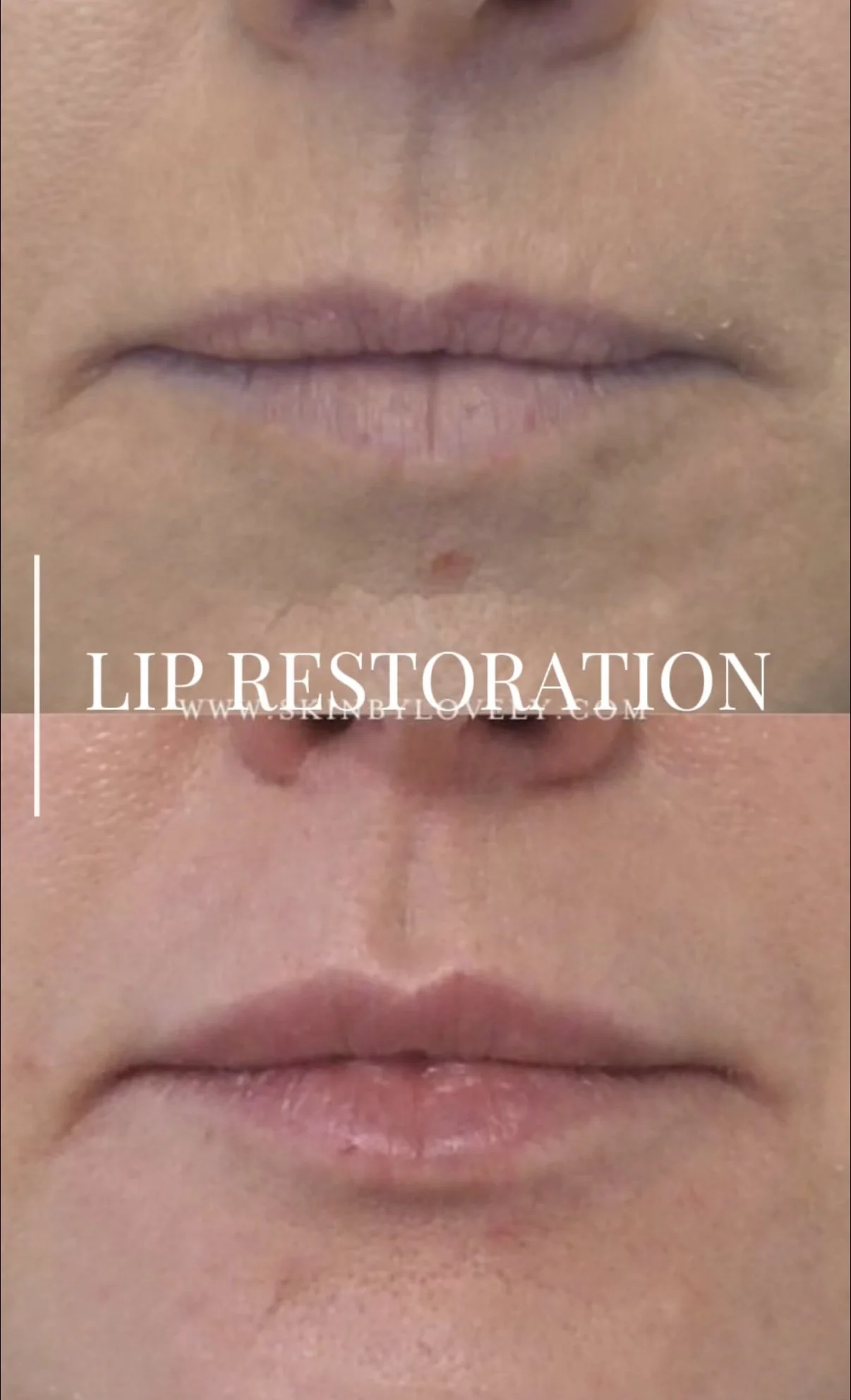 Lip Restoration with Filler 