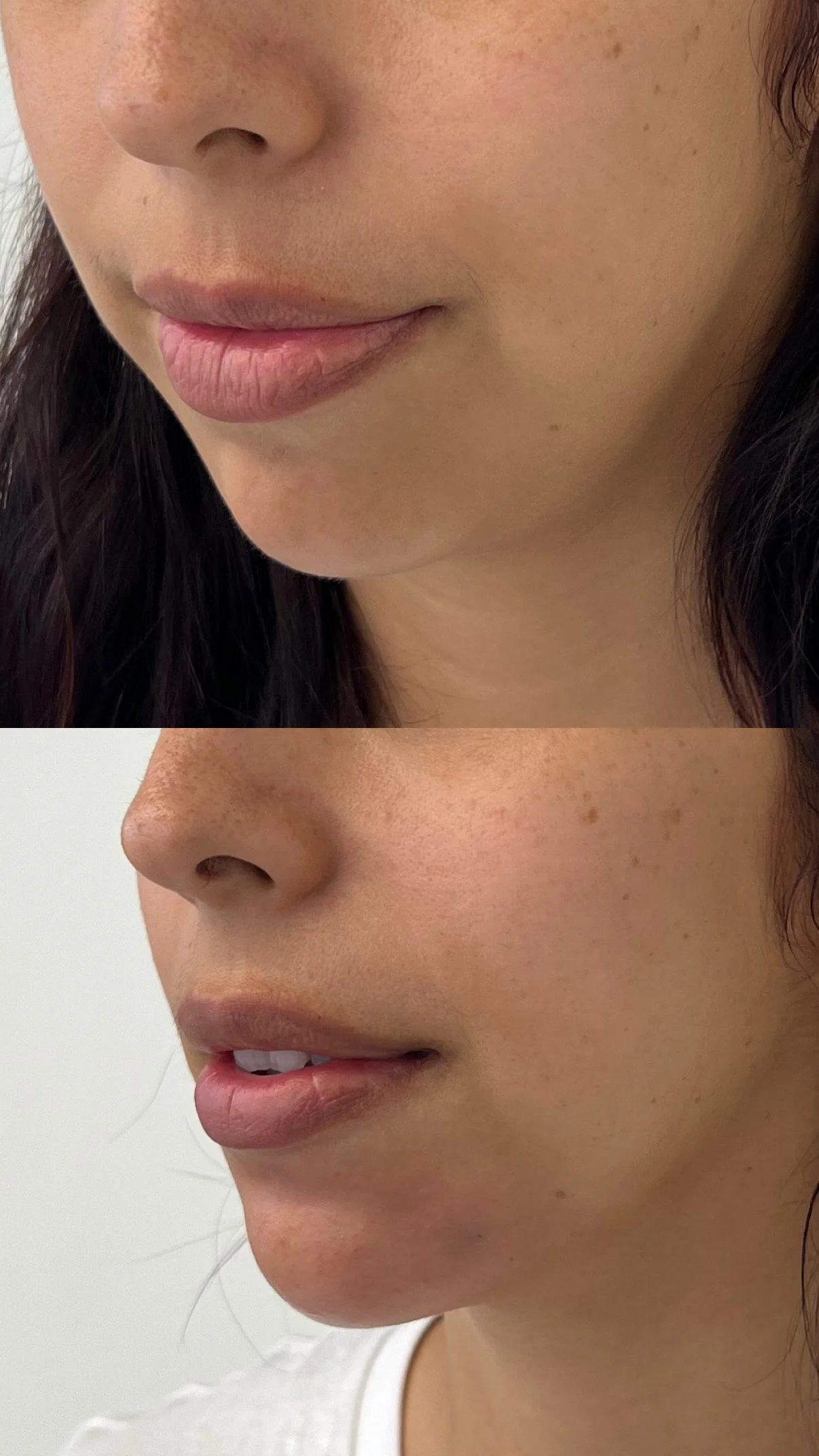 Chin elongation with filler 