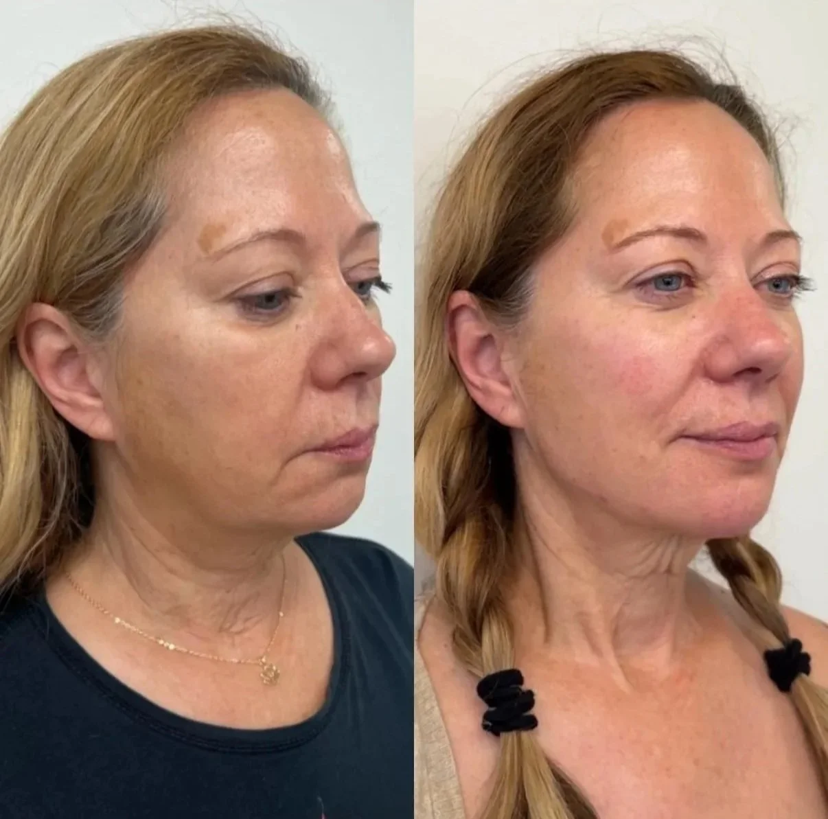 Facial Balancing with filler 