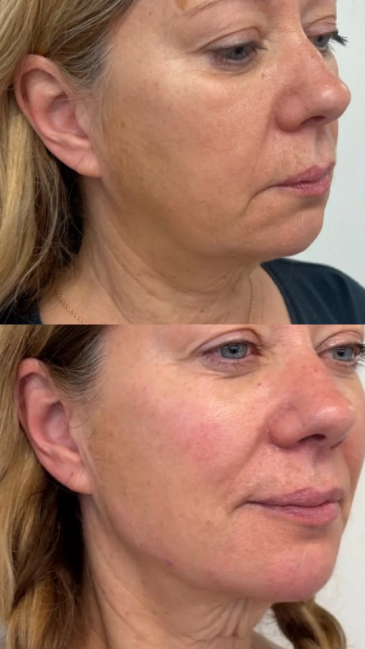 Facial Balancing with filler 