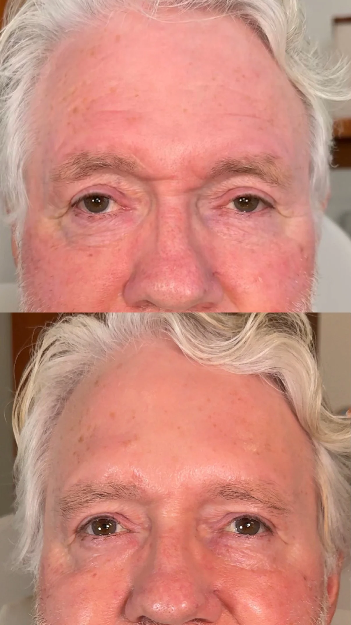 Before and after results showing softened forehead lines and reduced redness, Boon Aesthetic Wellness in Claremont, CA