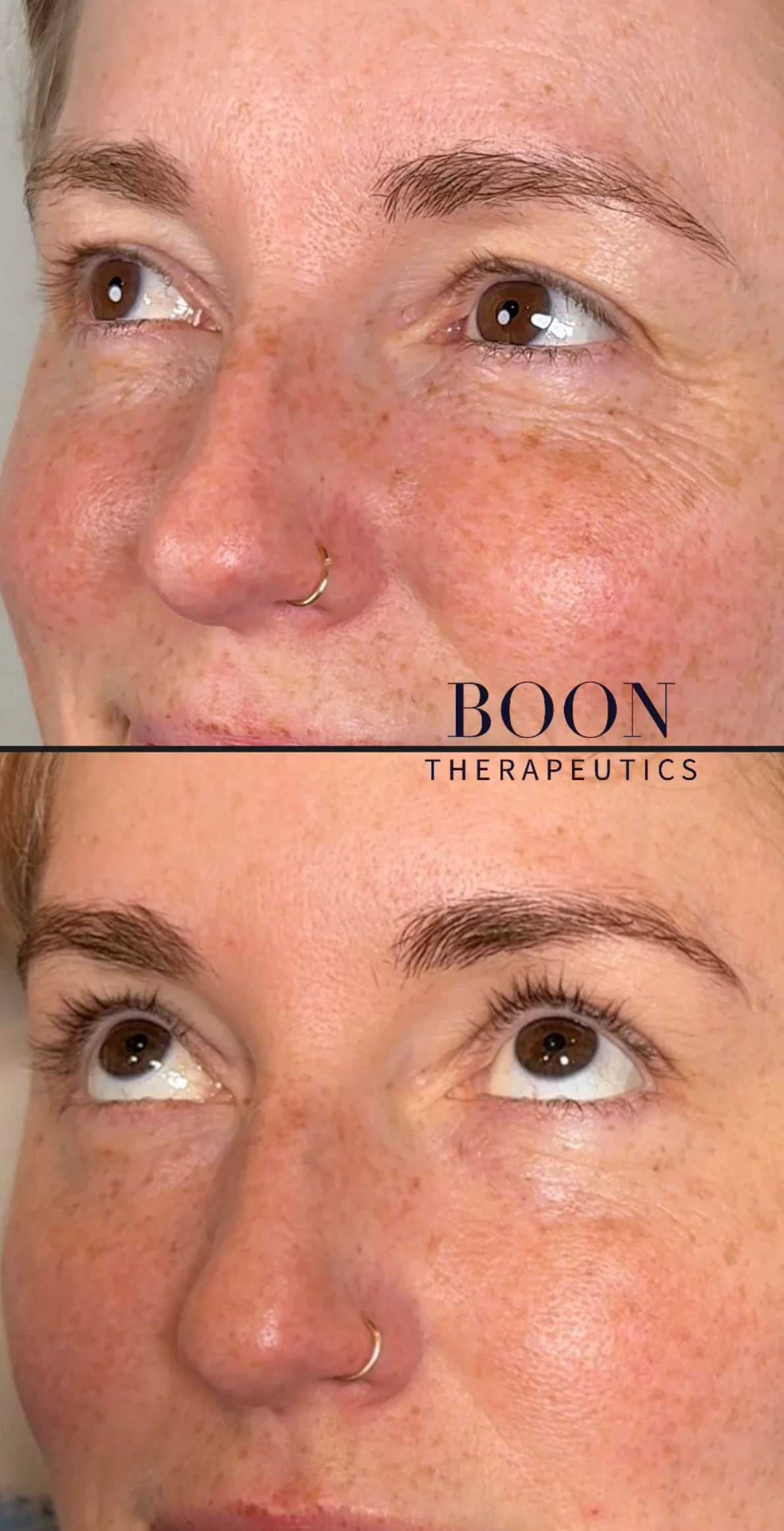 Under eye Rejuvenation with PDGF 