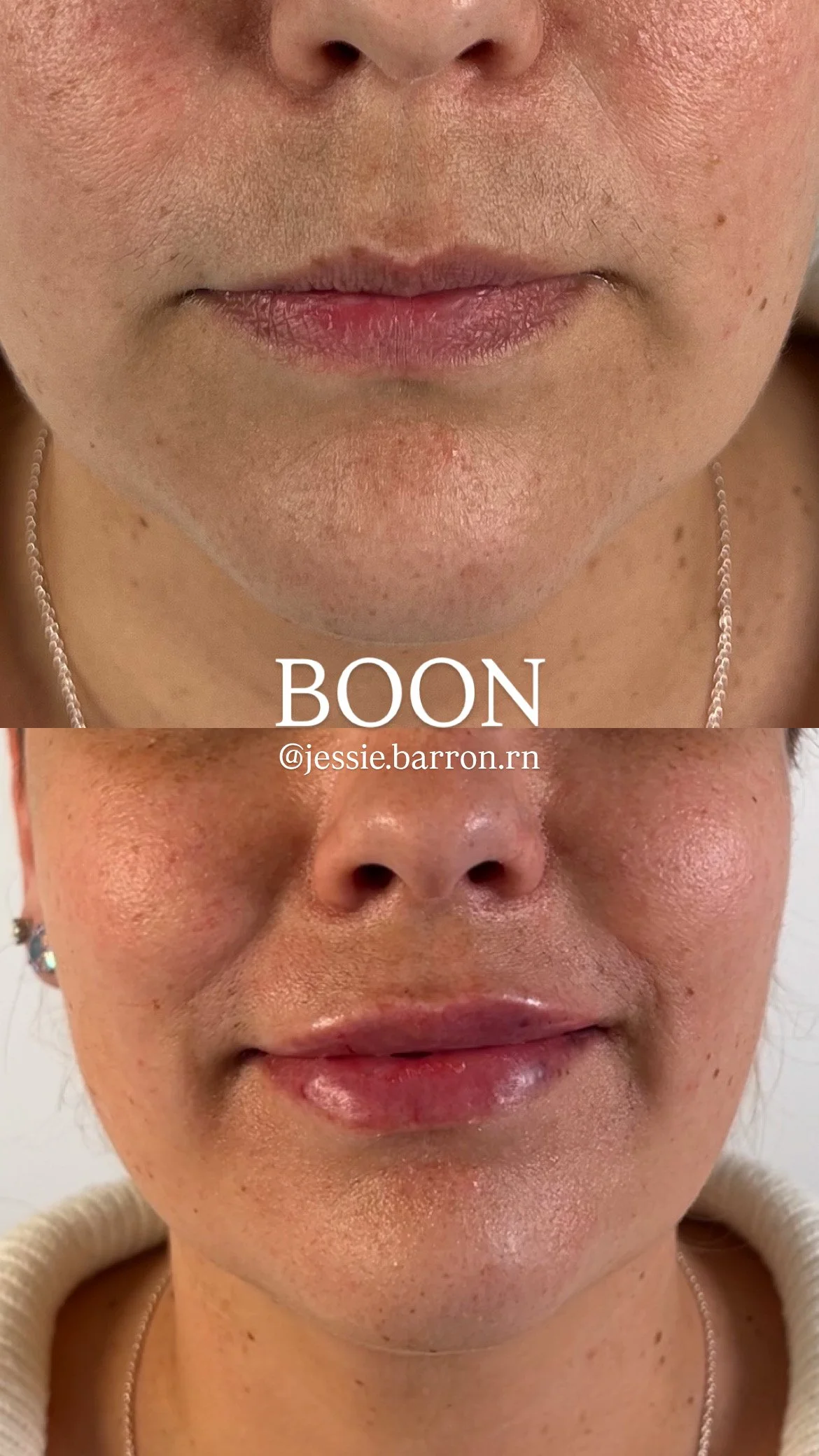 Lip enhancement with filler 