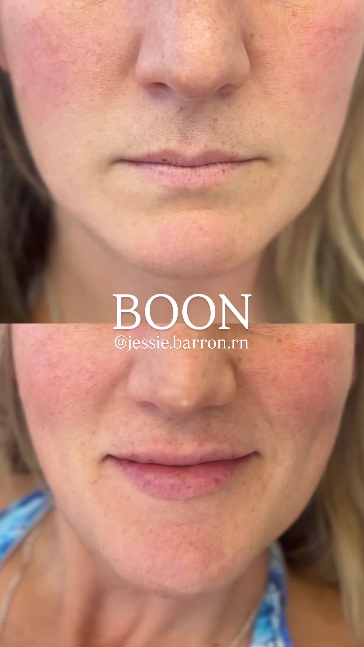 Lip enhancement with filler 