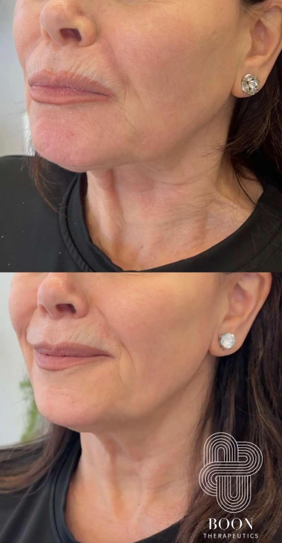 Jawline Tightening with Botox