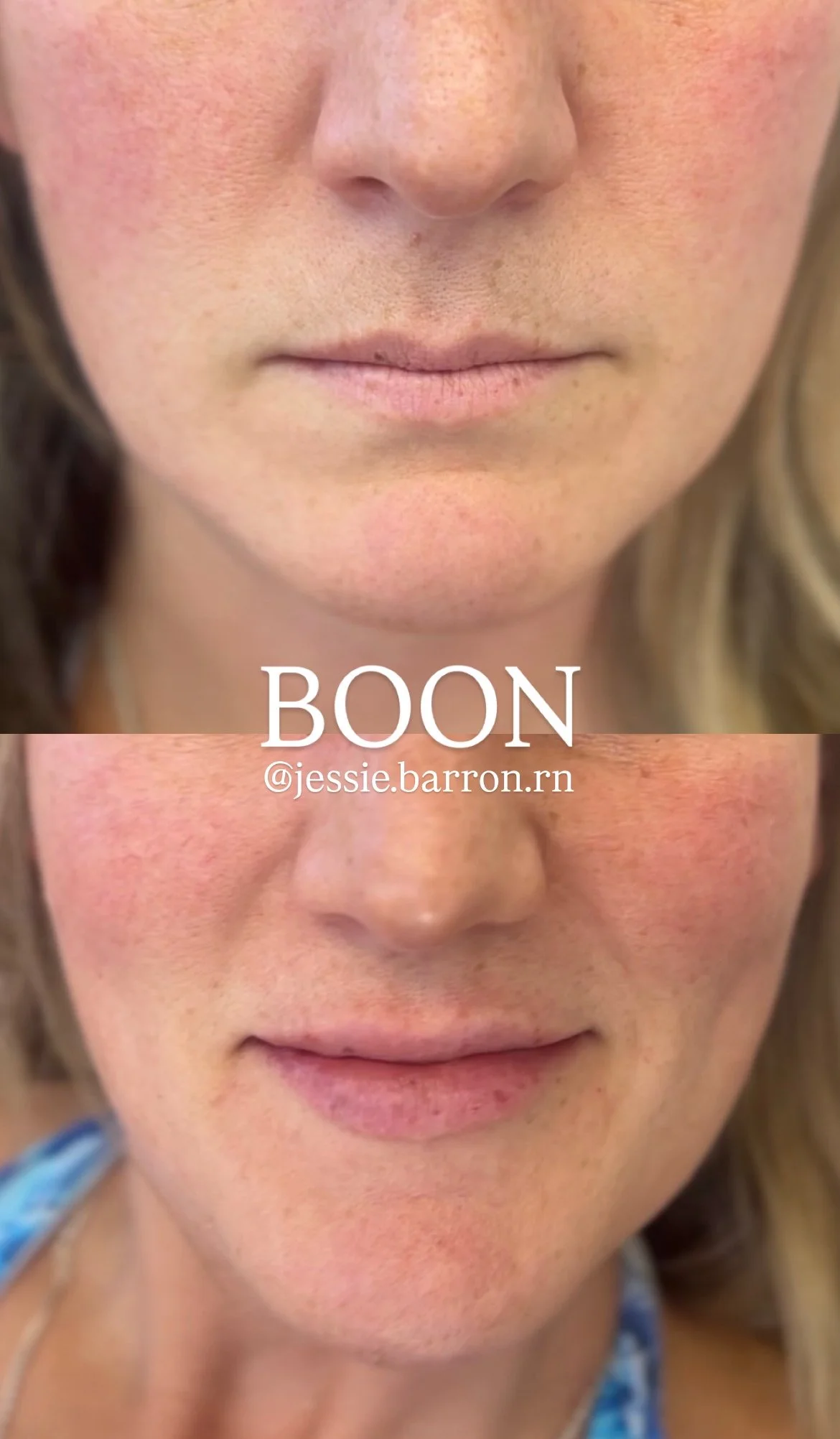 Natural lip enhancement with filler 