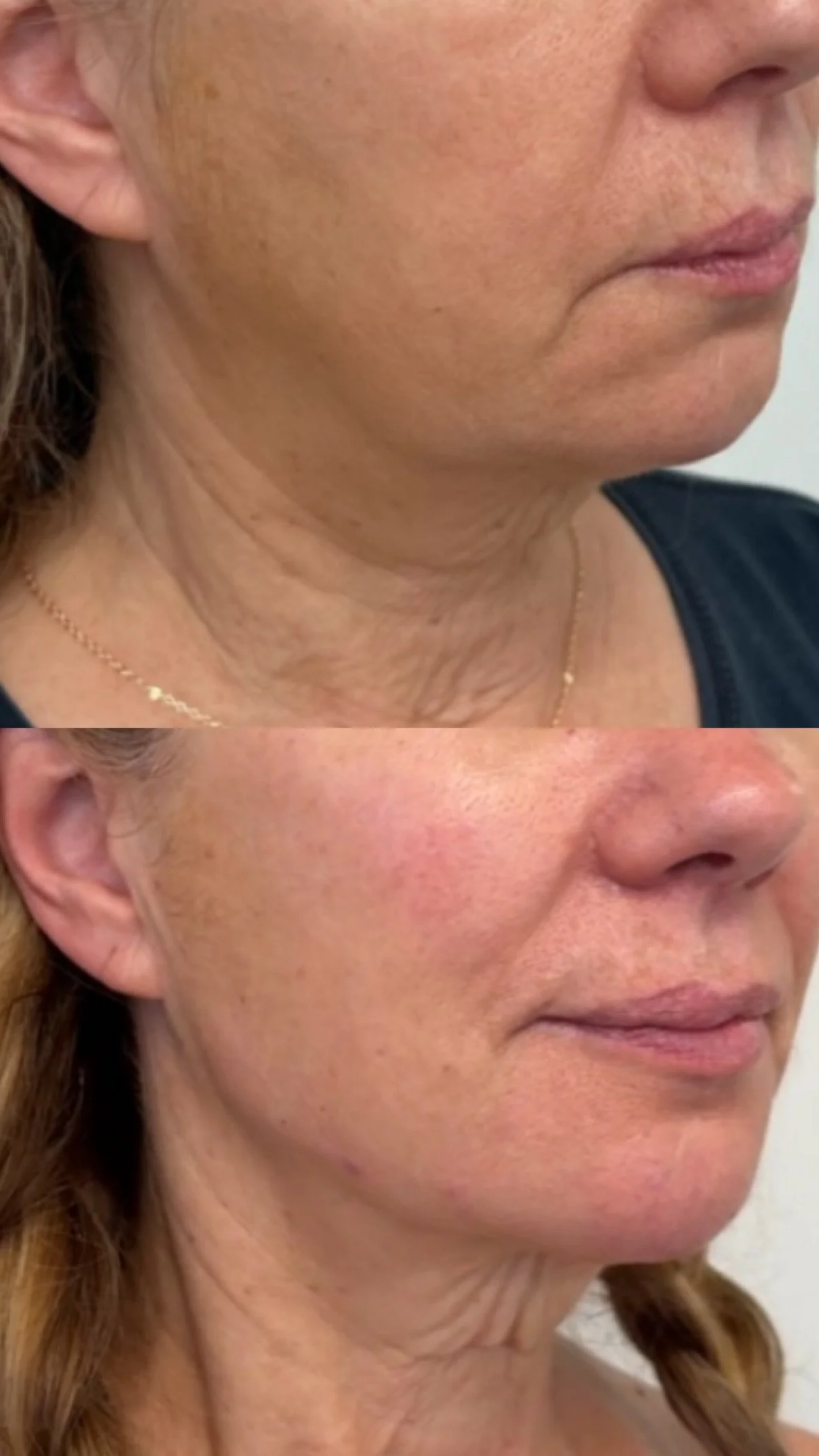 Facial Balancing with filler 