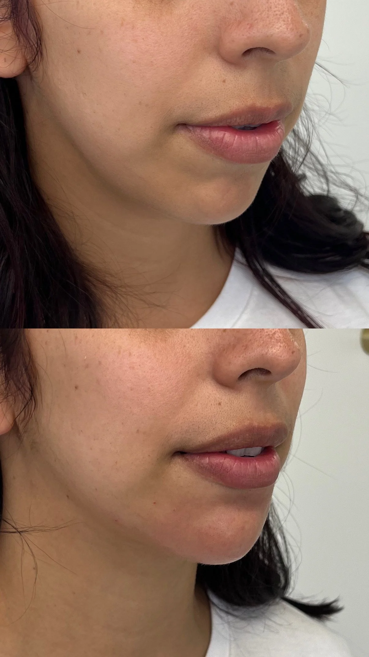 Chin elongation with filler 