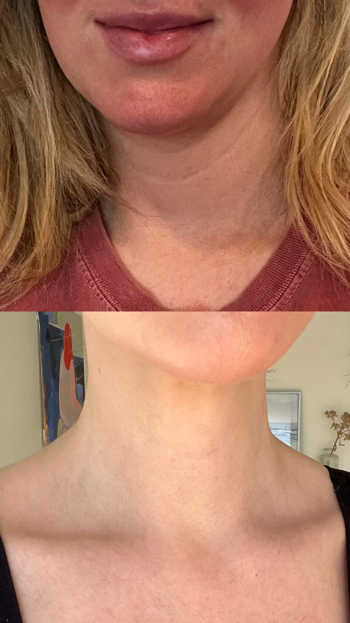Neck rejuvenation with Hyperdilute Radiesse