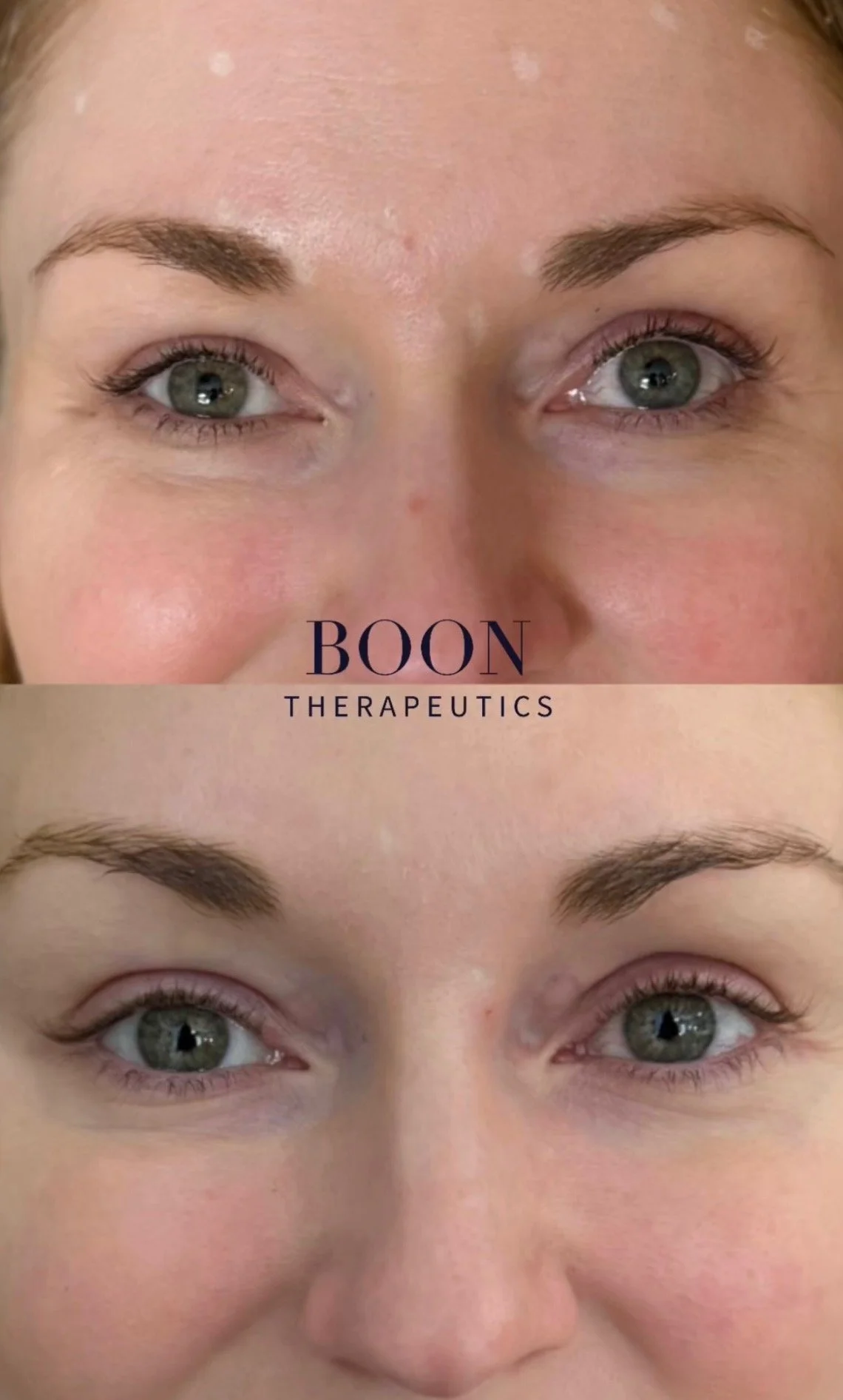 Eyelid symmetry and lifting with botox
