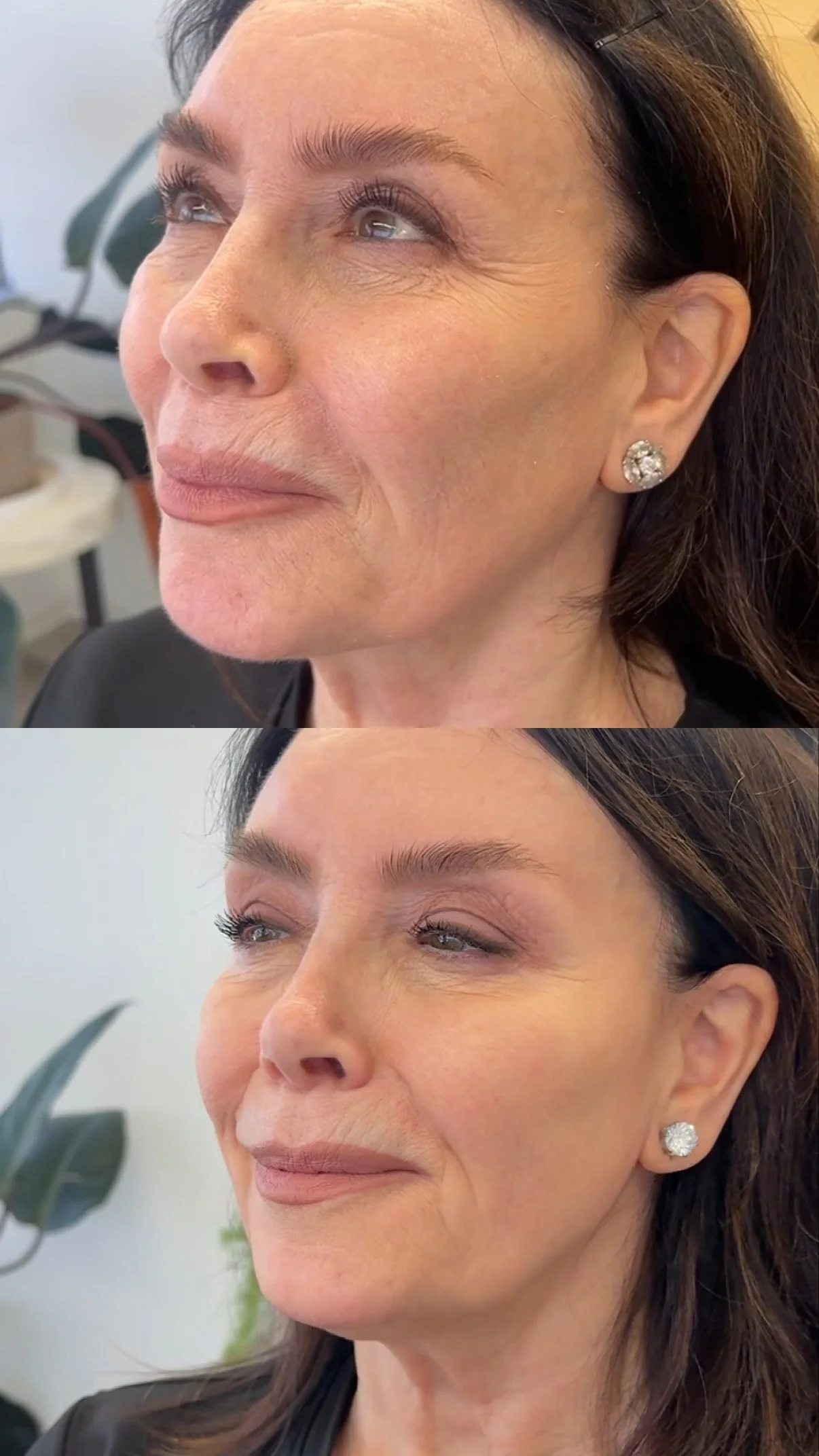 Full face botox rejuvenation