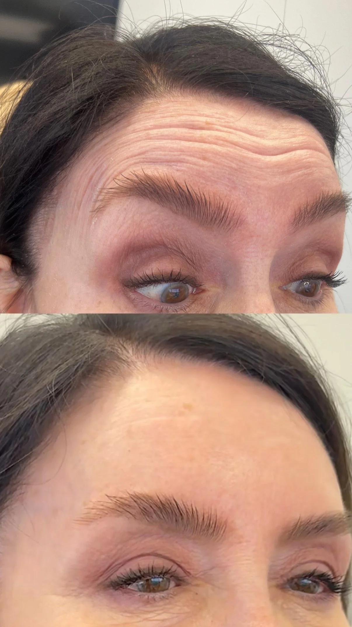 Forehead smoothing with Botox 