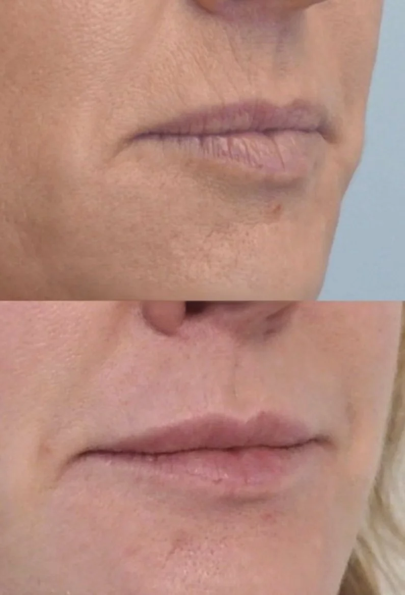 Lip Restoration with Filler 