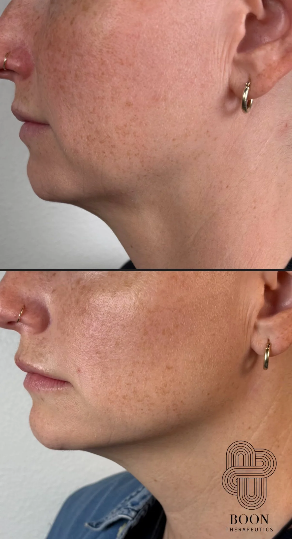 Jowl reduction with HA filler and Botox 