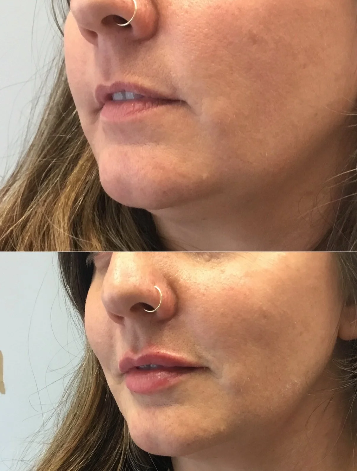 Lip enhancement with filler 