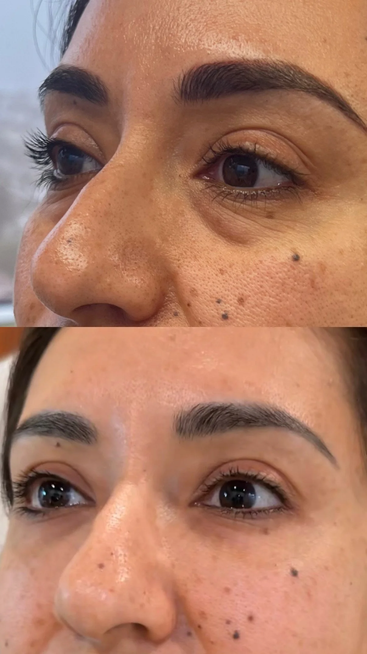 Before and after undereye rejuvenation results around the eyes and brow area, Boon Aesthetic Wellness in Claremont, CA