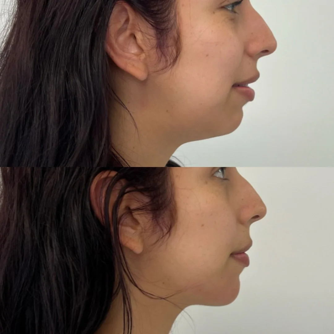 Chin elongation with filler