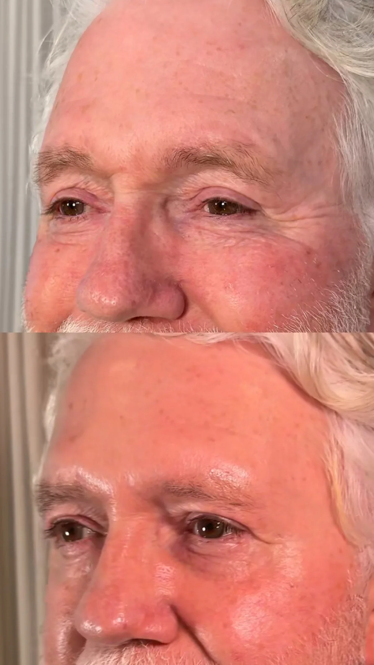 Before and after treatment results showing refined skin texture on the face, Boon Aesthetic Wellness in Claremont, CA
