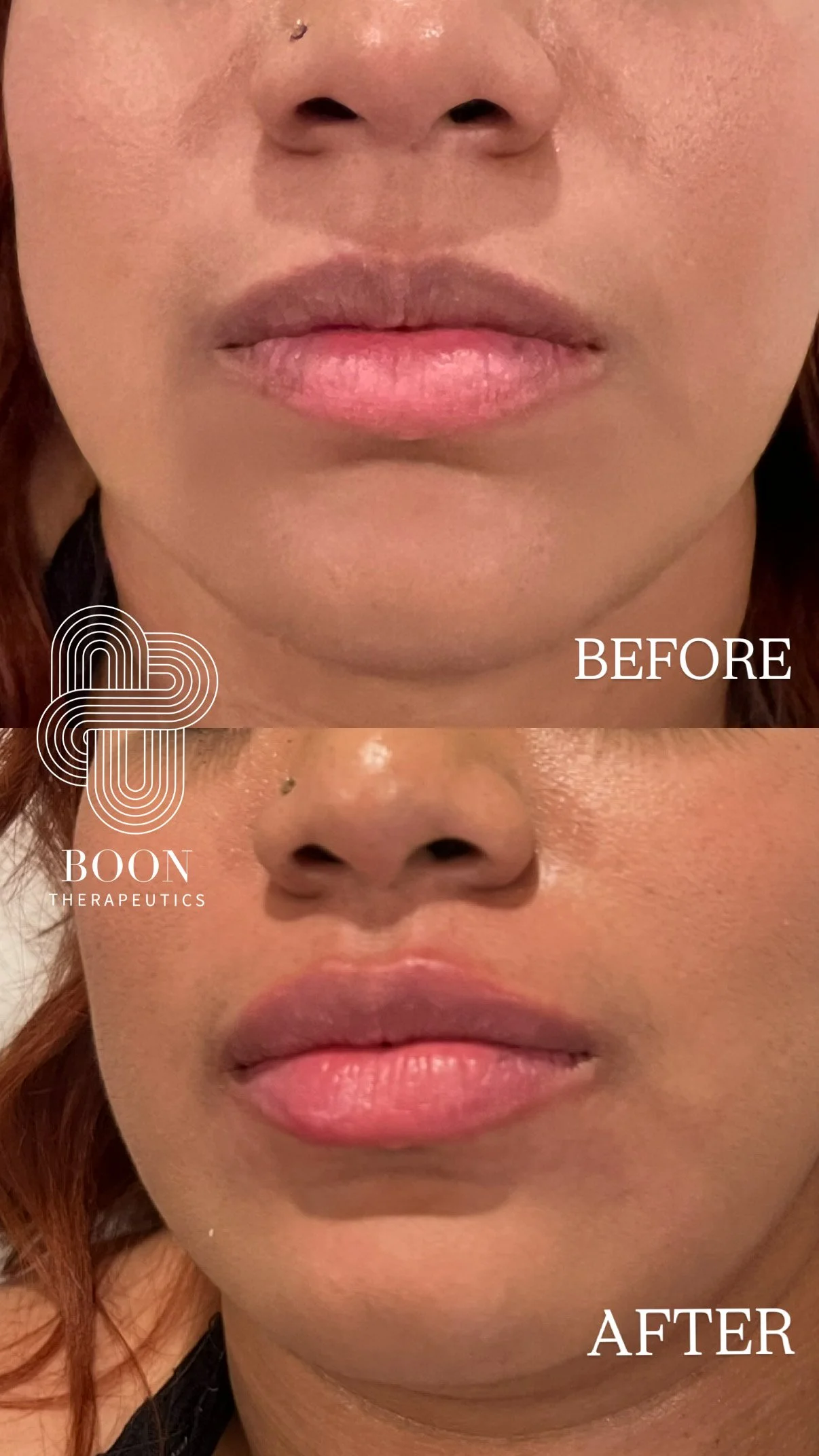 Lip border enhancement with filler