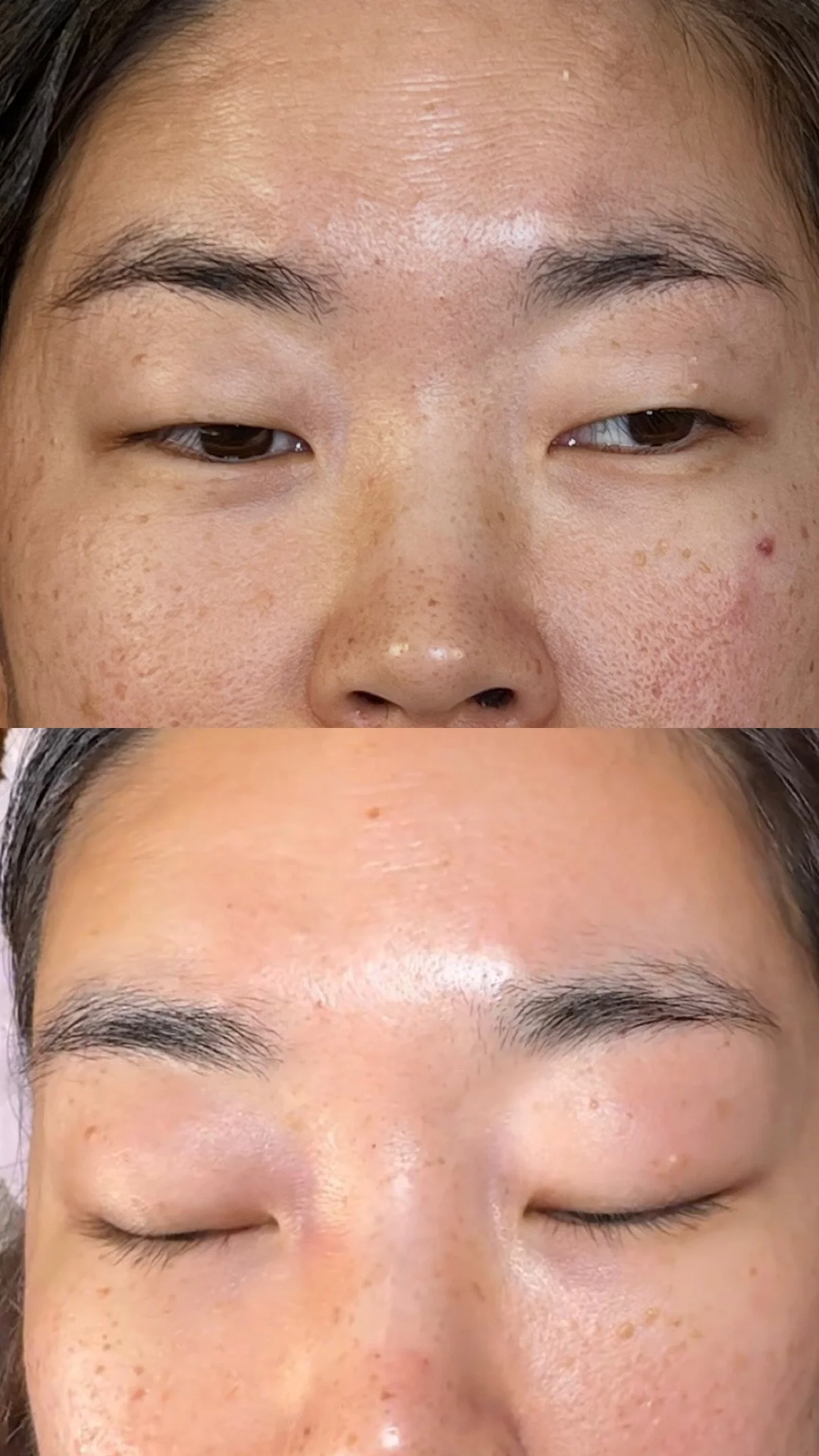 Before and after skin treatment results showing clearer skin and refined pores, Boon Aesthetic Wellness in Claremont, CA