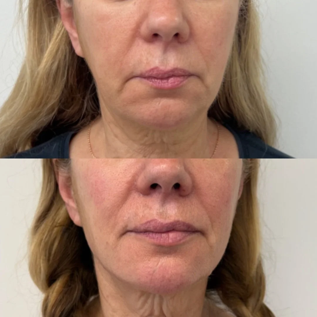 Lower face balancing with filler 