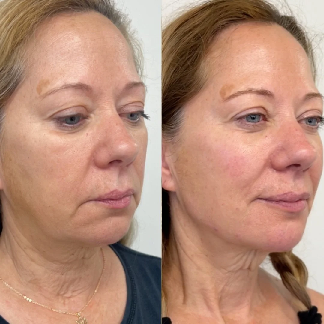 Facial Balancing with Filler