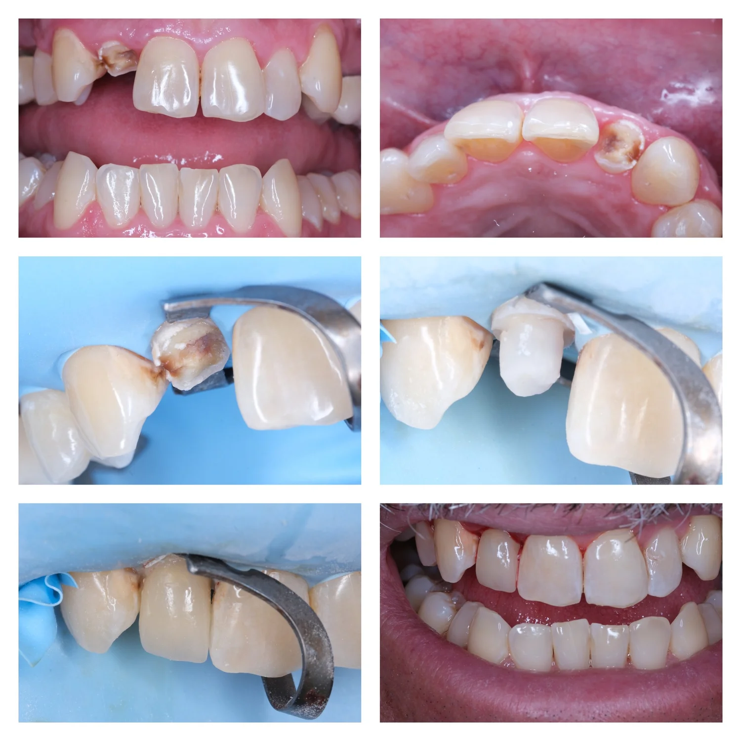 Fallbrook Minimally Invasive Dentistry – Patient Examples