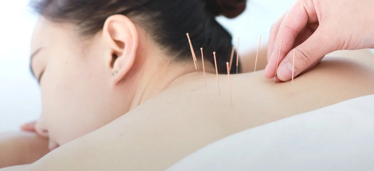 acupuncture-near-me-rvc.jpg