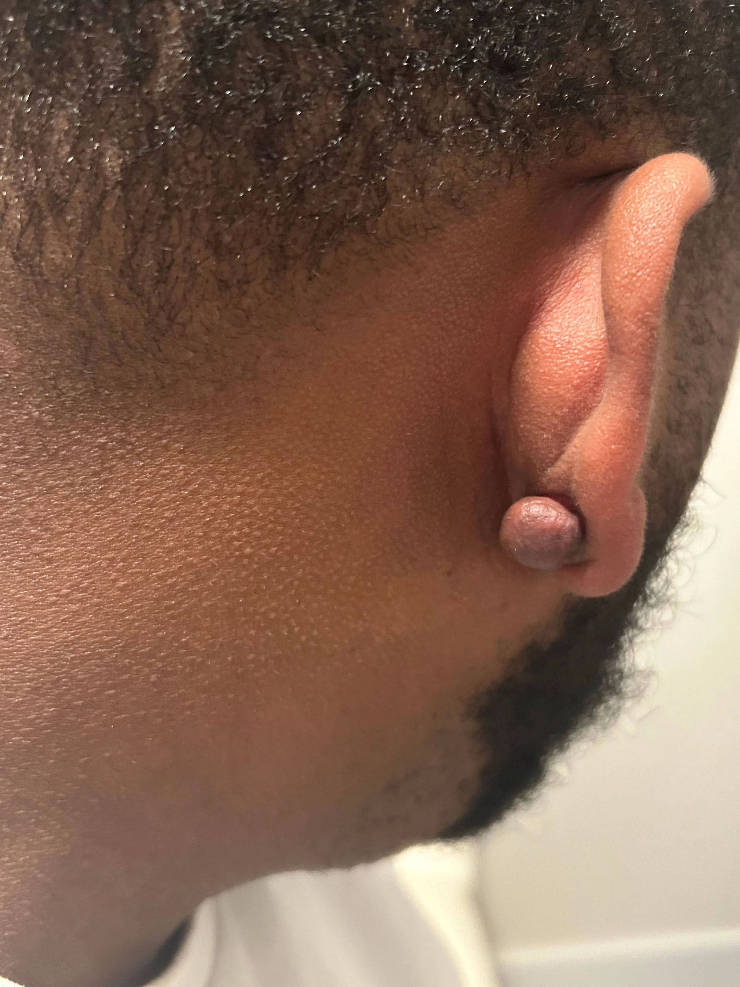 Keloids, not your ordinary lesion.