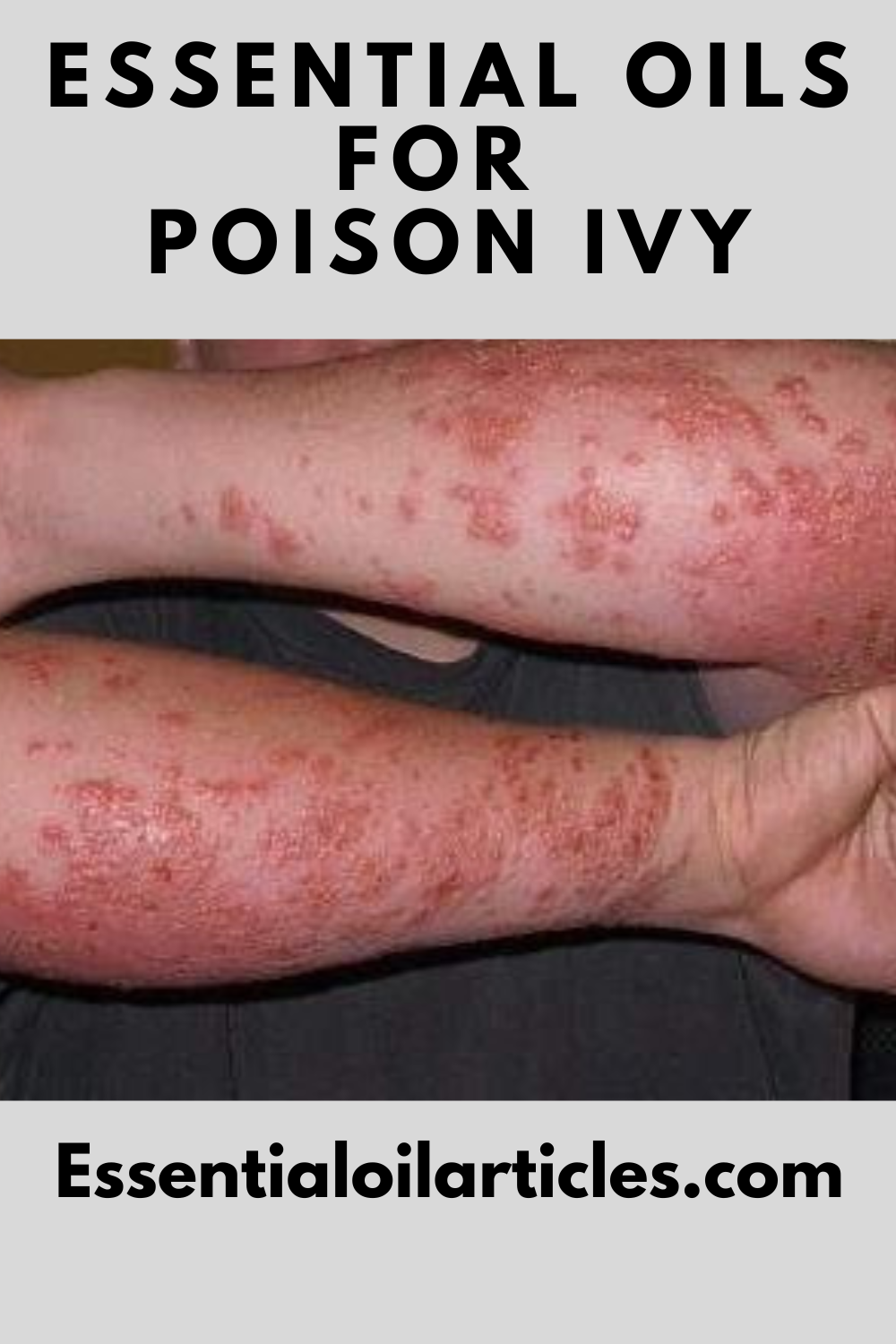 Essential Oils for Poison Ivy