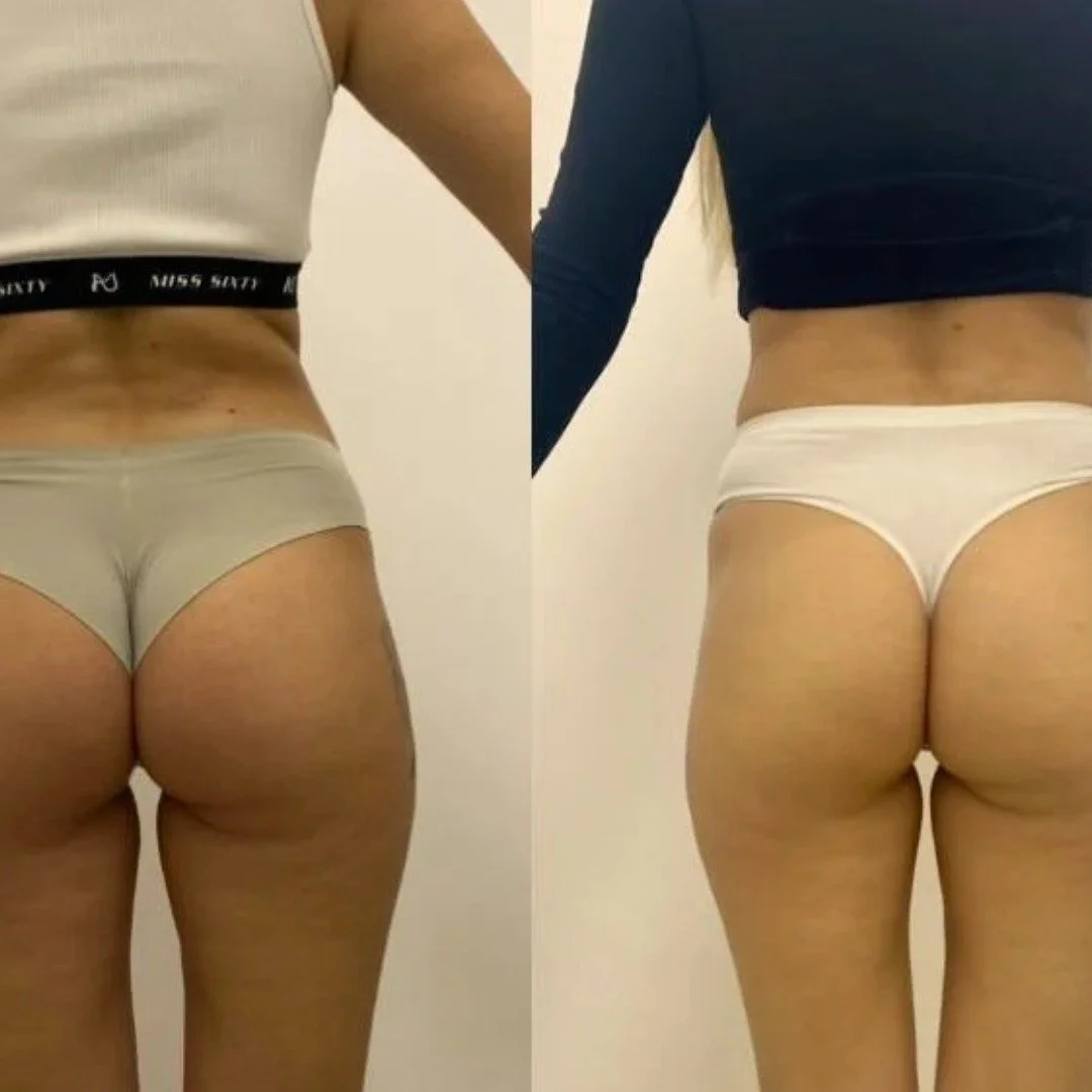 Chicago Before and After weight loss and cellulite treatment on legs and knee tightening 