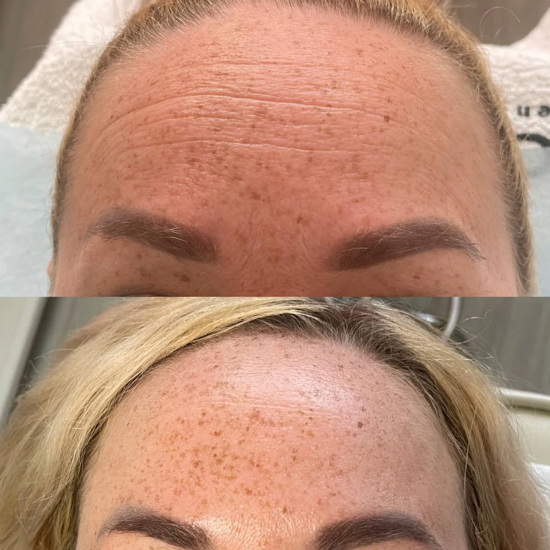 Botox Before and after Gold Coast Chicago