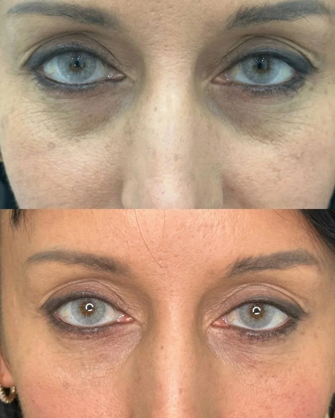 botox before and after Gold Coast Chicago 