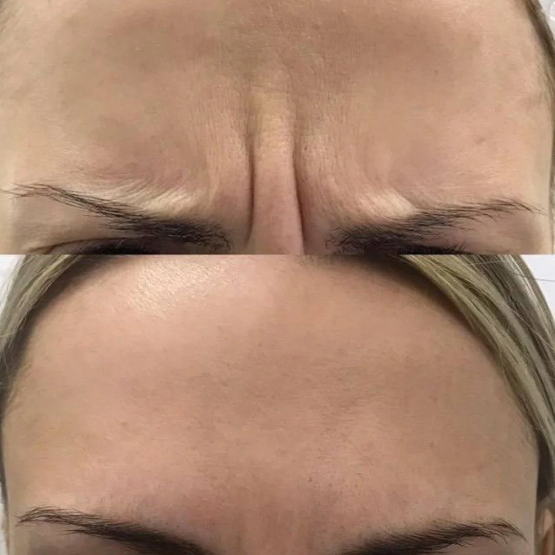 Botox before and after Gold Coast Chicago 