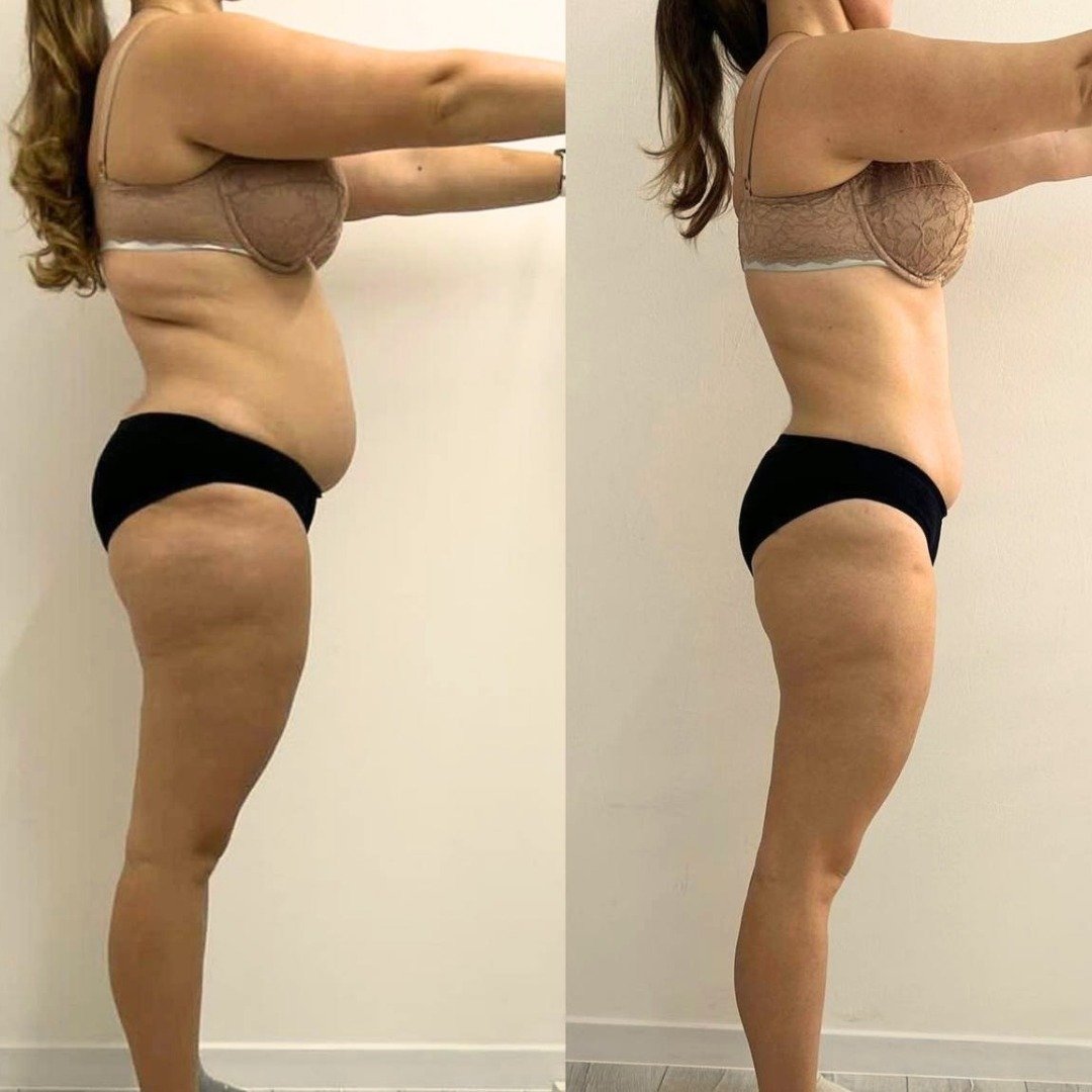 before and after weight loss Chicago treatments