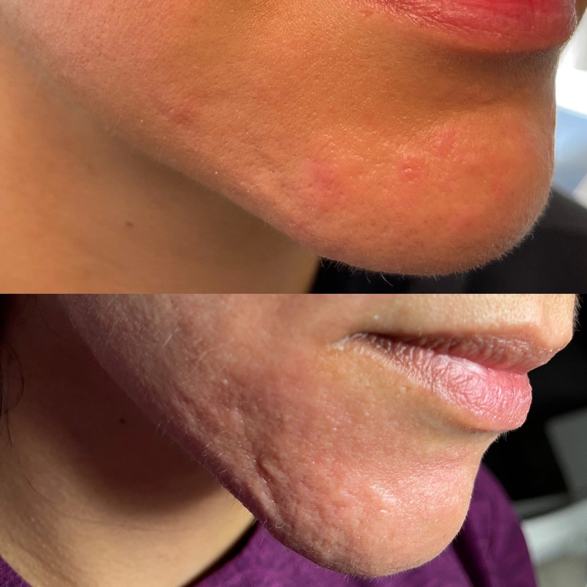 before and after skin tightening and eye bags Chicago Gold Coast