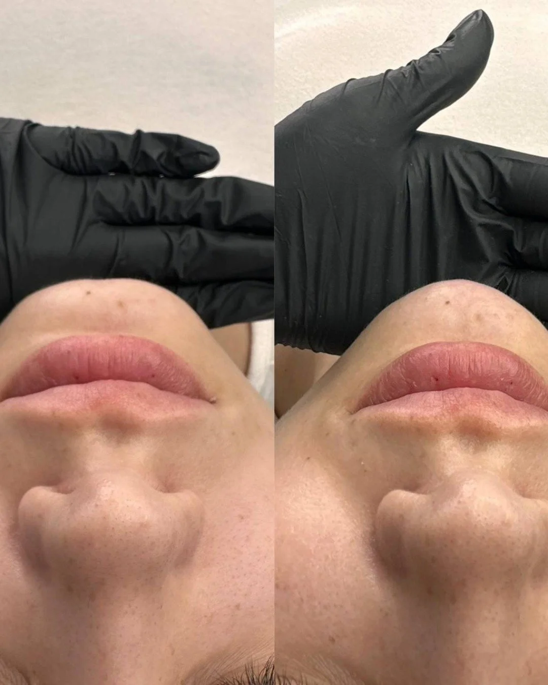 Botox Before and after Gold Coast Chicago