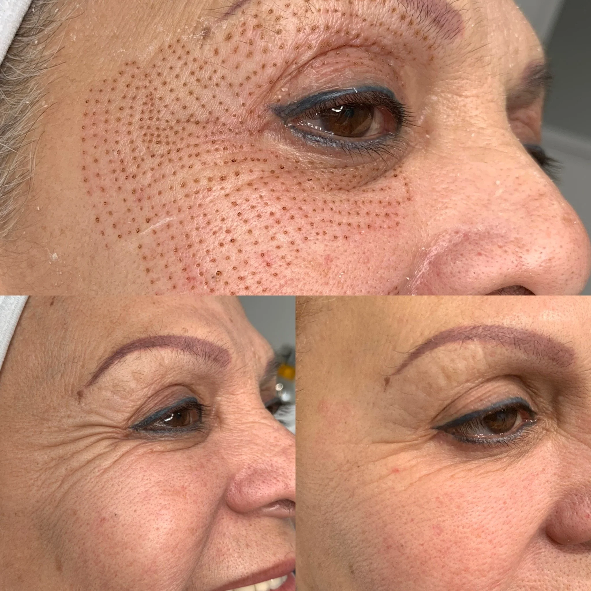 plasma pen before and after Chicago Gold Coast